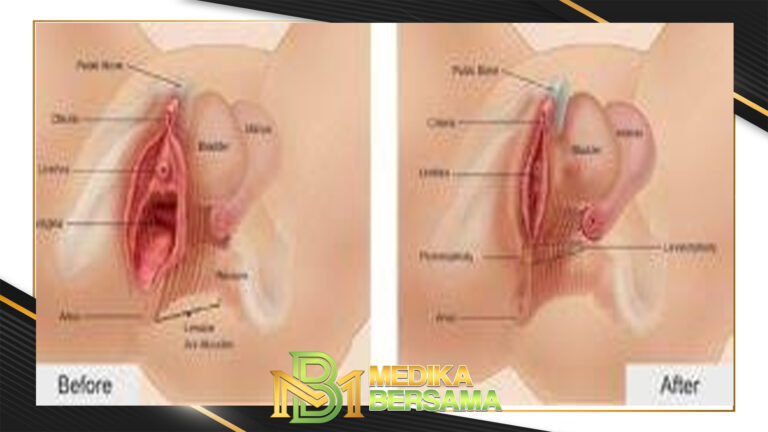 4 Cara Mengencangkan Vagina Kendur