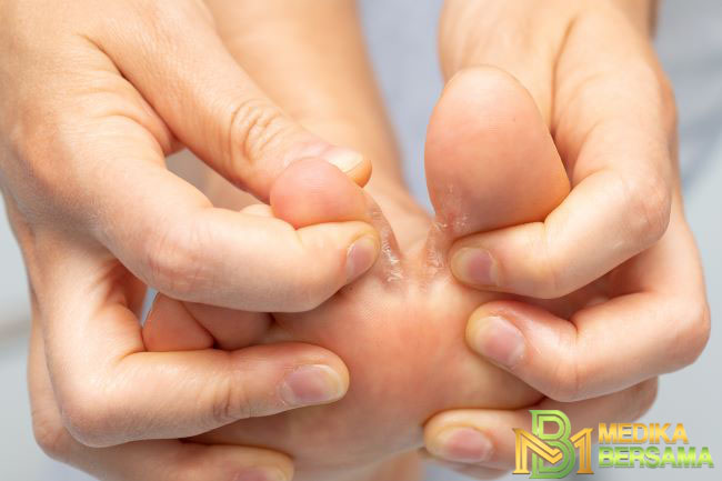 Cara Membasmi Kutu Air pada Kaki